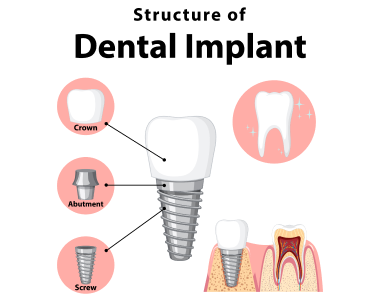 dental implants Harrisonburg VA